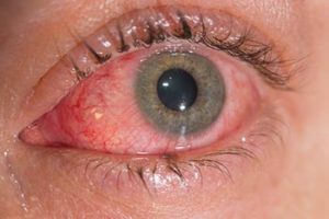 conjuntivitis.2